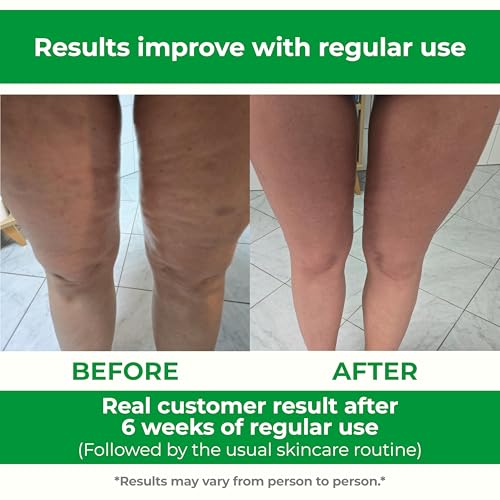 Anti Cellulite Roller & Lymphatic Drainage Massager | Fascia Blaster for Contoured & Smoother Skin | Tool for Sore Arms, Legs, Stomach & Buttocks Multicolor